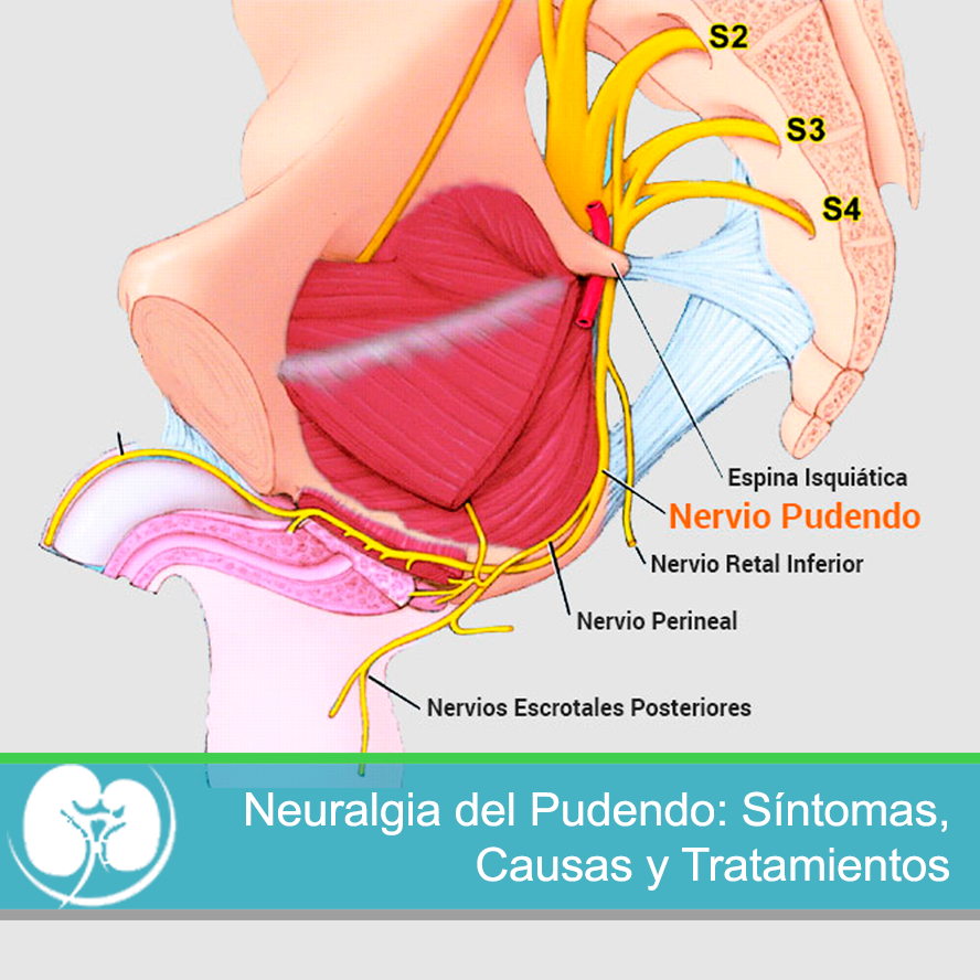 Neuralgia del Pudendo: Síntomas, Causas y Tratamientos - Urólogo en Alicante
