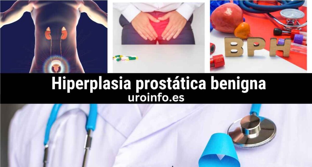 La hiperplasia prostática benigna